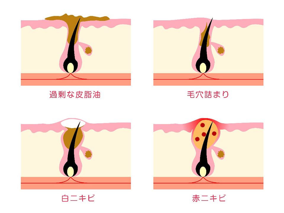 毛穴とニキビの関係イメージ