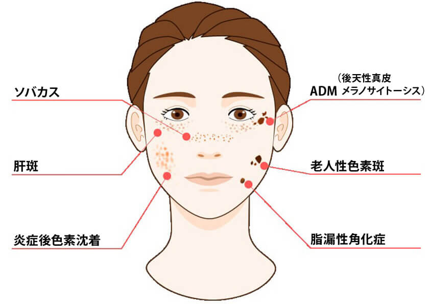 肝斑とは？