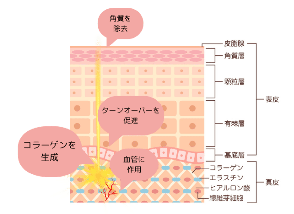 赤ら顔・ニキビ跡の赤み改善