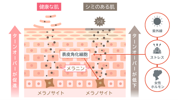 シミができる原因