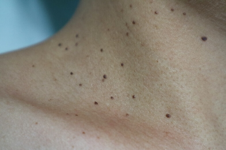 軟性線維腫(アクロコルドン)