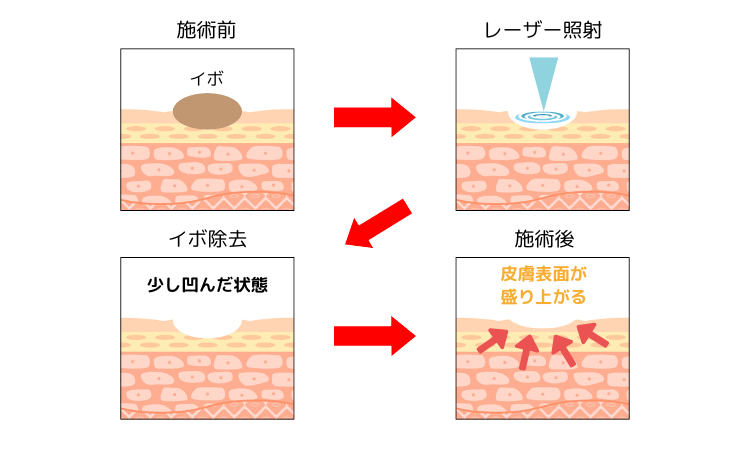 イボのCO2レーザー治療